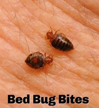 How to treat bed bug bites
